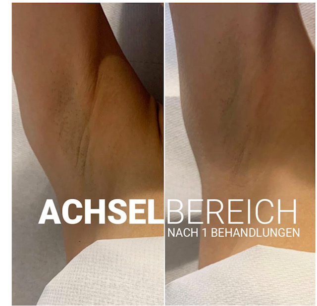 nach Behandlung Fibrom 