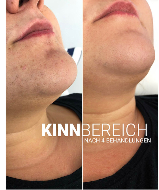 nach Behandlung Couperose 